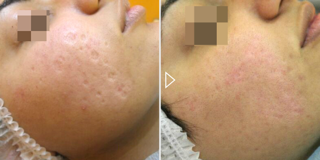 ↪Lu_41азерный пилинг (чистка) - фото до и после