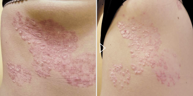 Лечение псориаза - фото до и после