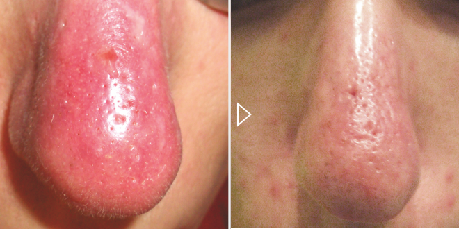 Лазерное лечение ринофимы - фото до и после