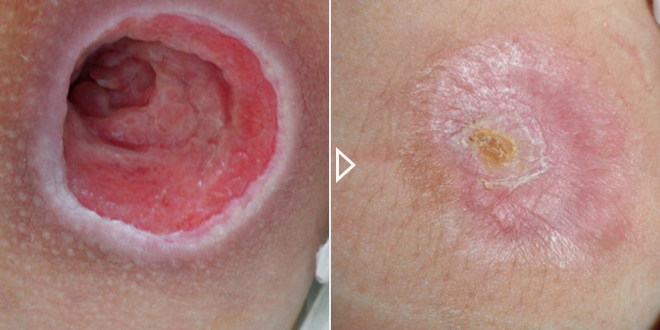 Accélération de la cicatrisation des plaies aiguës et chroniques