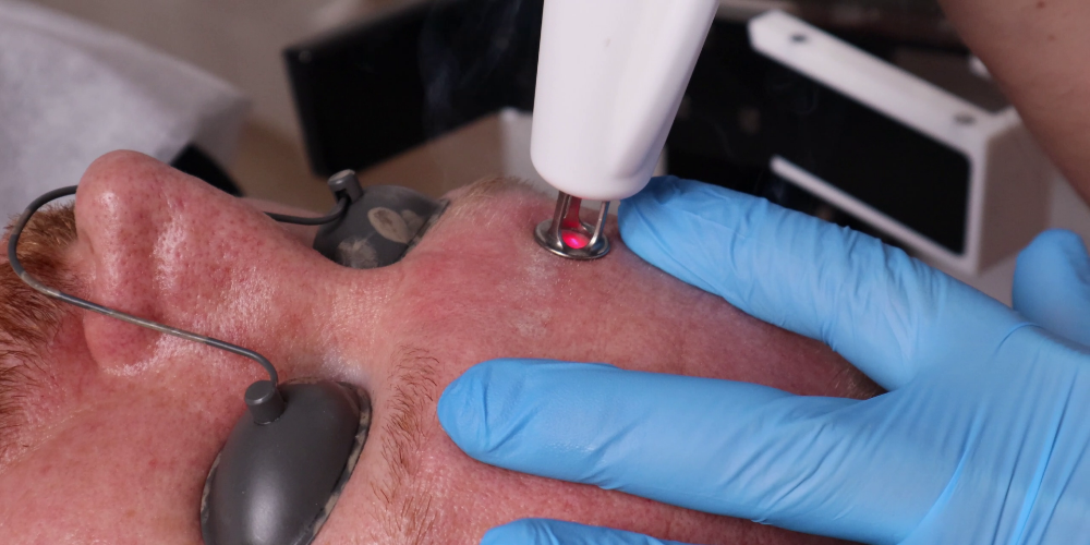 RecoSMA® - Une percée dans la technologie de régénération au laser