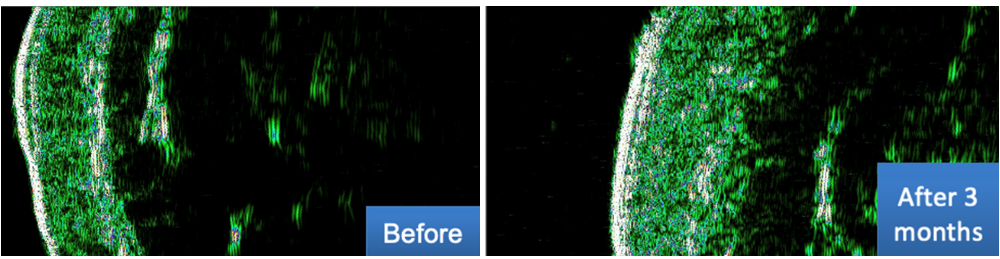 Image ultrasonore DUB Cutis, 22 MHz